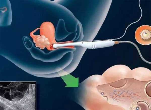 无排卵不孕治疗_高龄试管生子_赴泰国试管婴儿流程攻略（详细过程）